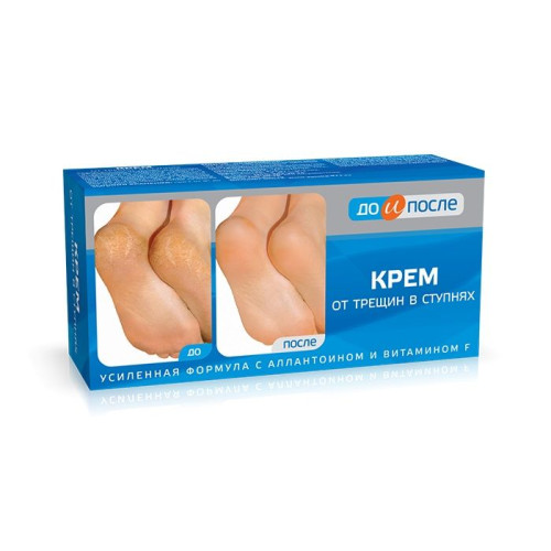 Before and After Cream for Cracked and Injured Feet and Heels 5.07 fl oz (150 ml)