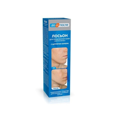 Before and After Anti-Acne Lotion for Removing Acne on Problem Skin 6.76 fl oz (200 ml)